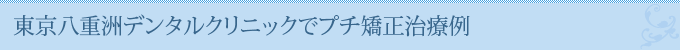 東京八重洲デンタルクリニックでプチ矯正治療例